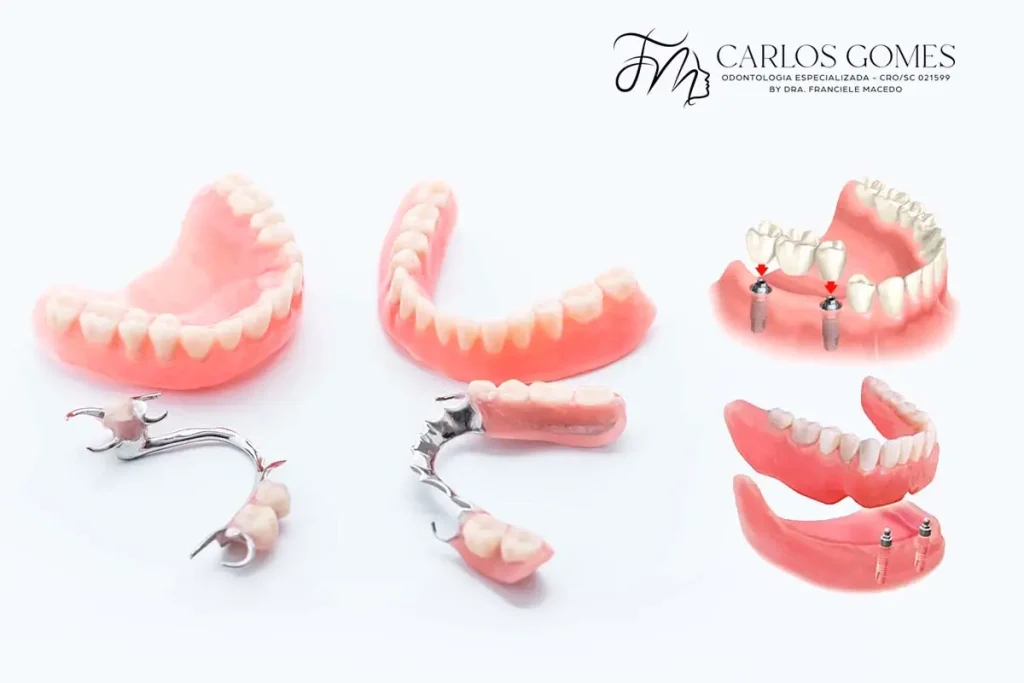 Principais Tipos de Próteses Dentárias. - Carlos Gomes Odontologia em Blumenau/SC.