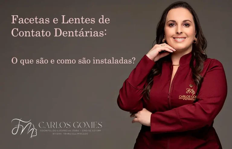 Facetas Dentárias, Lentes de Contato, O que são e Como são Instaladas. - Carlos Gomes Odontologia em Blumenau/SC