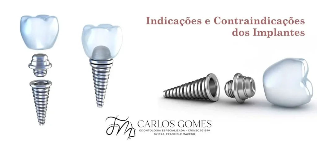 Implantodontia em Blumenau - Indicações e Contraindicações dos Implantes - Carlos Gomes Odontologia.