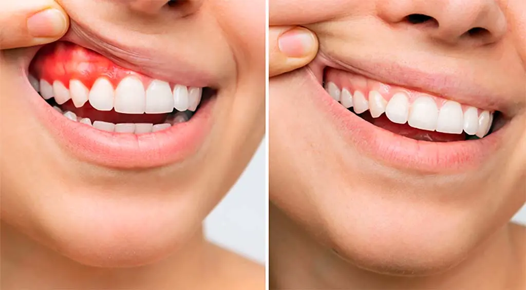 O que é Periodontia, o que Estuda, e o que ela Trata? - Carlos Gomes Odontologia em Blumenau/SC.