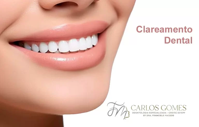Clareamento em Blumenau? Carlos Gomes Odontologia.