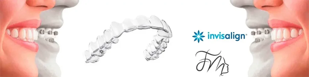 Vantagens do Tratamento com Alinhador Estético em Blumenau/SC - Carlos Gomes Odontologia.