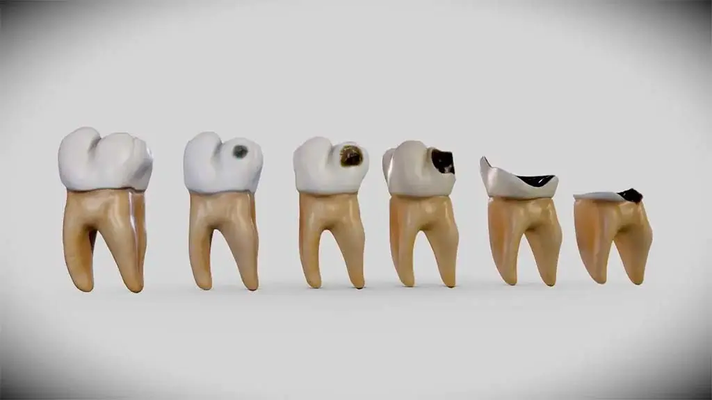 O Que é a Cárie Dental?