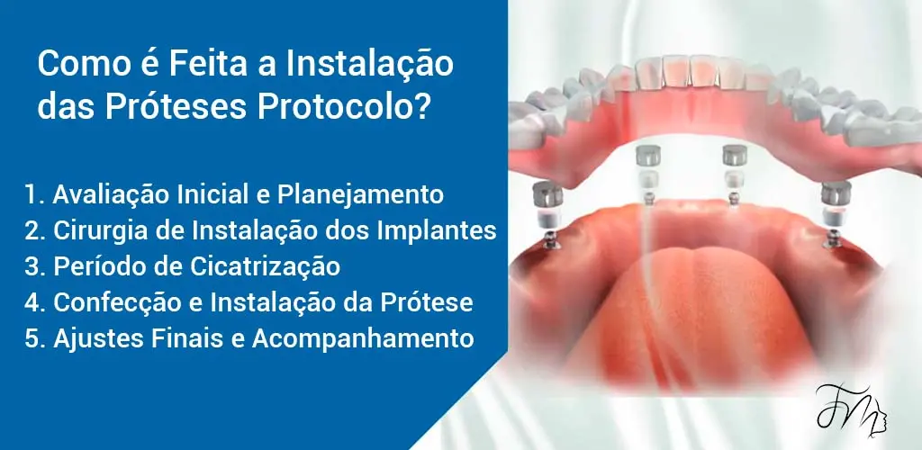 Como é Feita a Instalação das Próteses Protocolo em Blumenau?