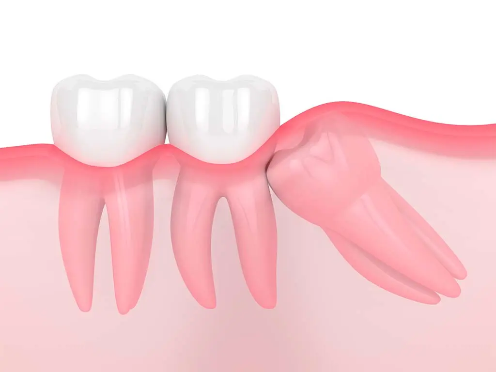 O que é um Dente do Siso Incluso ou Impactado