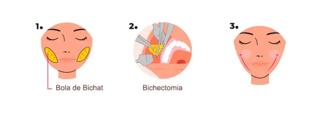 O Que É, Afinal, a Bichectomia?