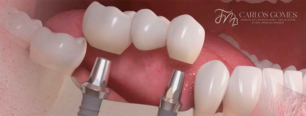 Acompanhamento profissional especializado para Implante Dentário em Blumenau - Carlos Gomes Odontologia Acompanhamento profissional especializado para Implante Dentário em Blumenau - Carlos Gomes Odontologia