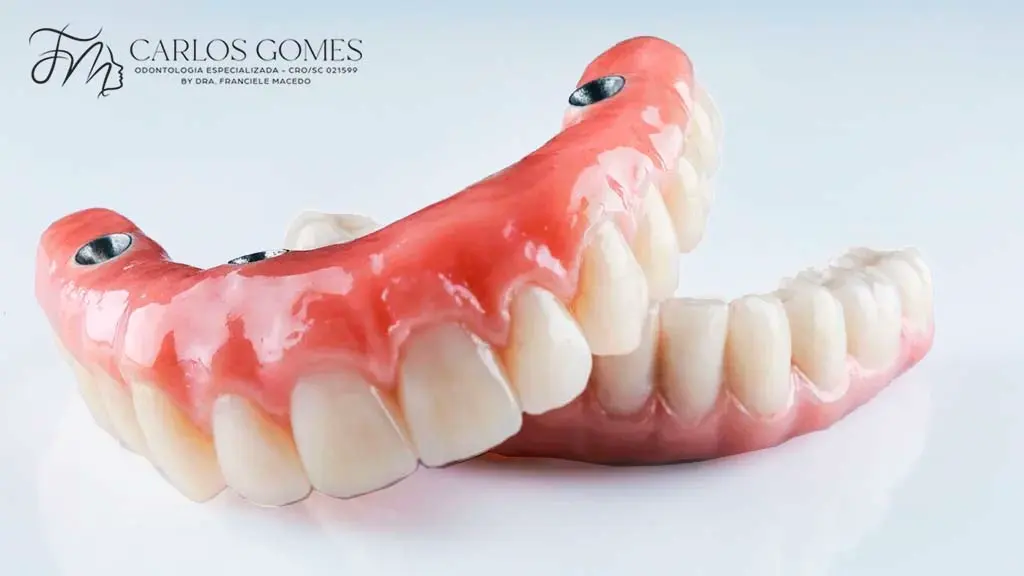 O que é a Prótese Sobre Implantes (Próteses Protocolo)