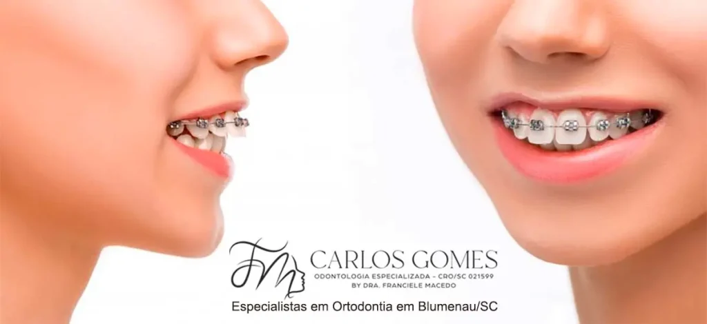 Especialistas em Ortodontia em Blumenau/SC - Carlos Gomes Odontologia.