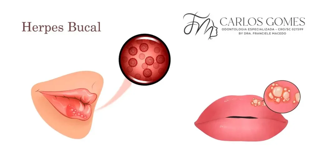 O que é exatamente a Herpes Bucal? - Carlos Gomes Odontologia em Blumenau/SC.