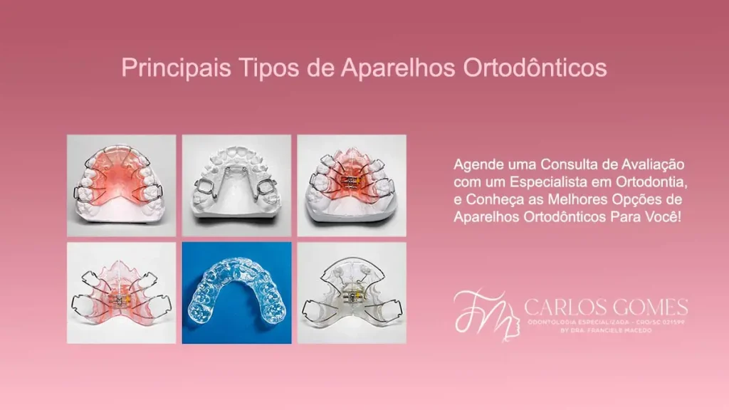 Tipos de Aparelhos em Nossa Clínica de Ortodontia em Blumenau/SC. - Carlos Gomes Odontologia.