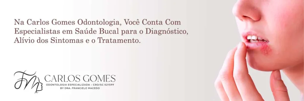 Tratamento de Herpes Bucal em Blumenau. - Carlos Gomes Odontologia.