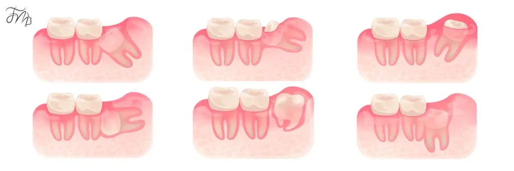 Por que Dentes do Siso Costumam ser um Problema? - Carlos Gomes Odontologia em Blumenau/SC