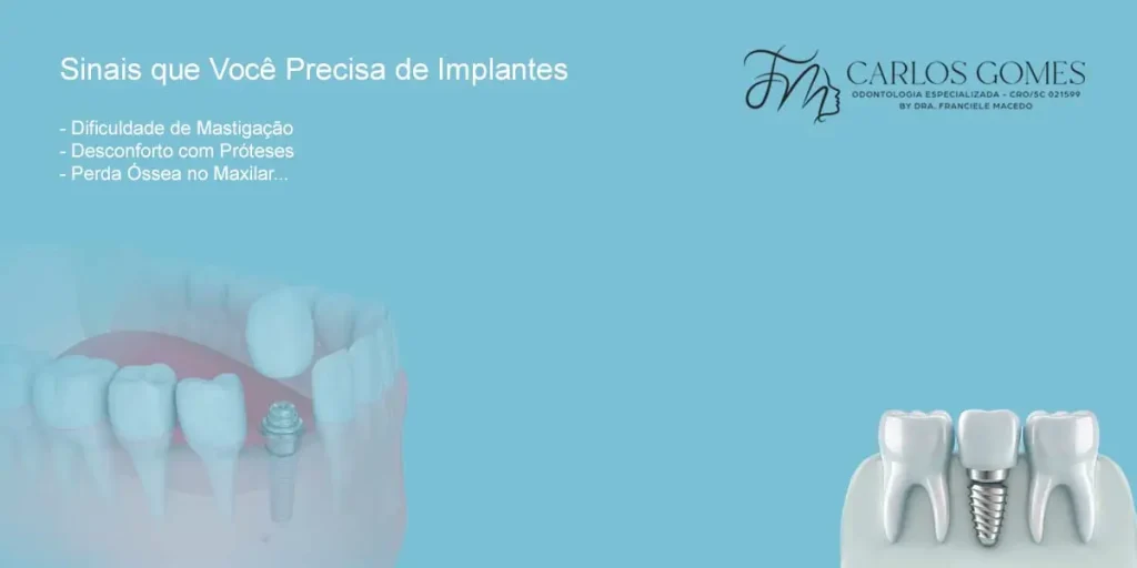 Implantes em Blumenau: Sinais que Indicam que Você Precisa de Implantes. - Carlos Gomes Odontologia.